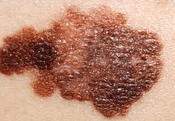 warning signs of melanoma